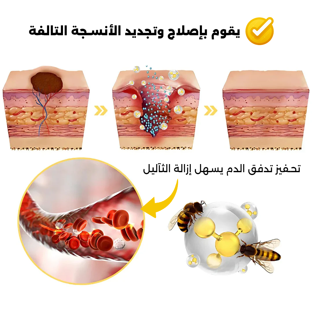 علاج الثآليل بسم النحل