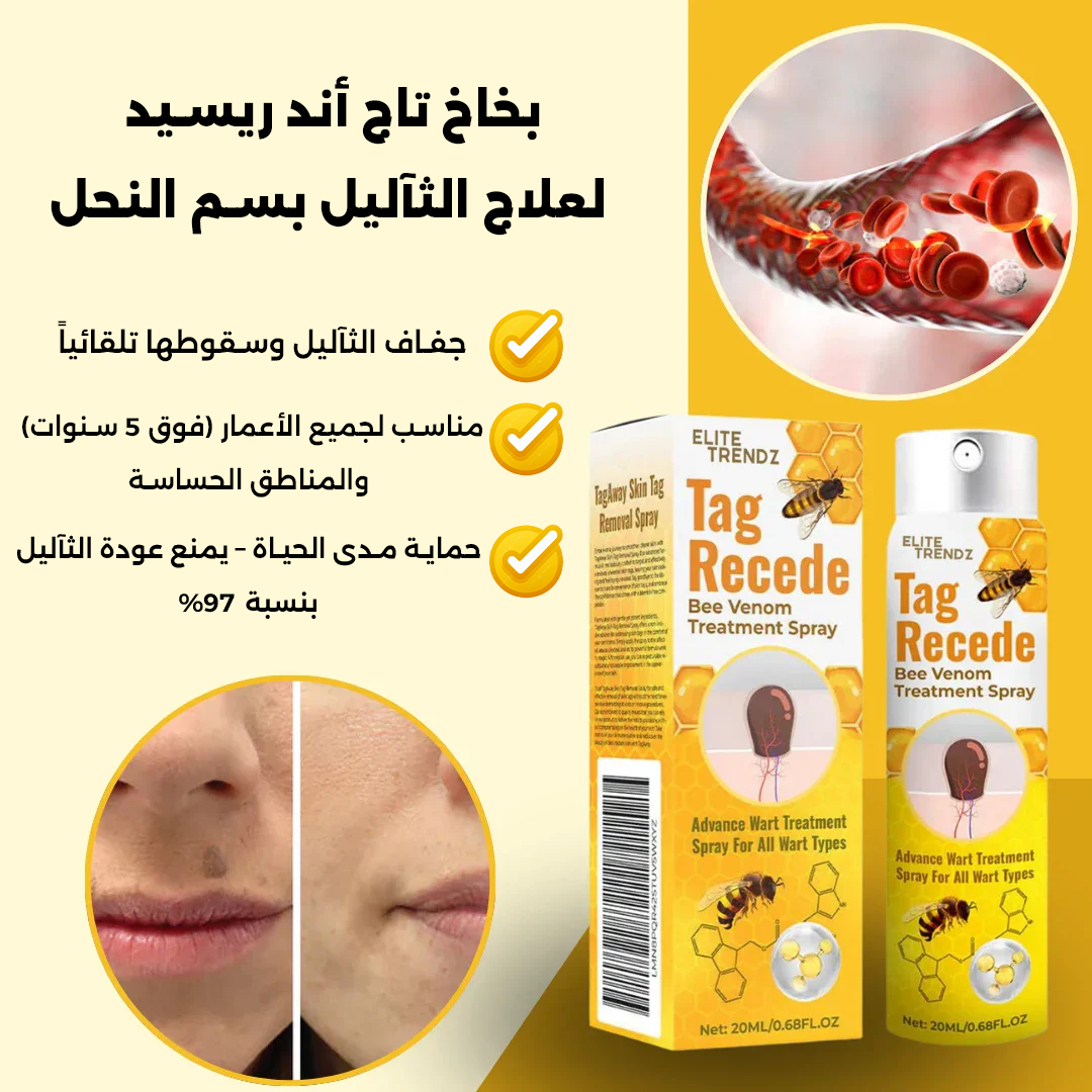 علاج الثآليل بسم النحل
