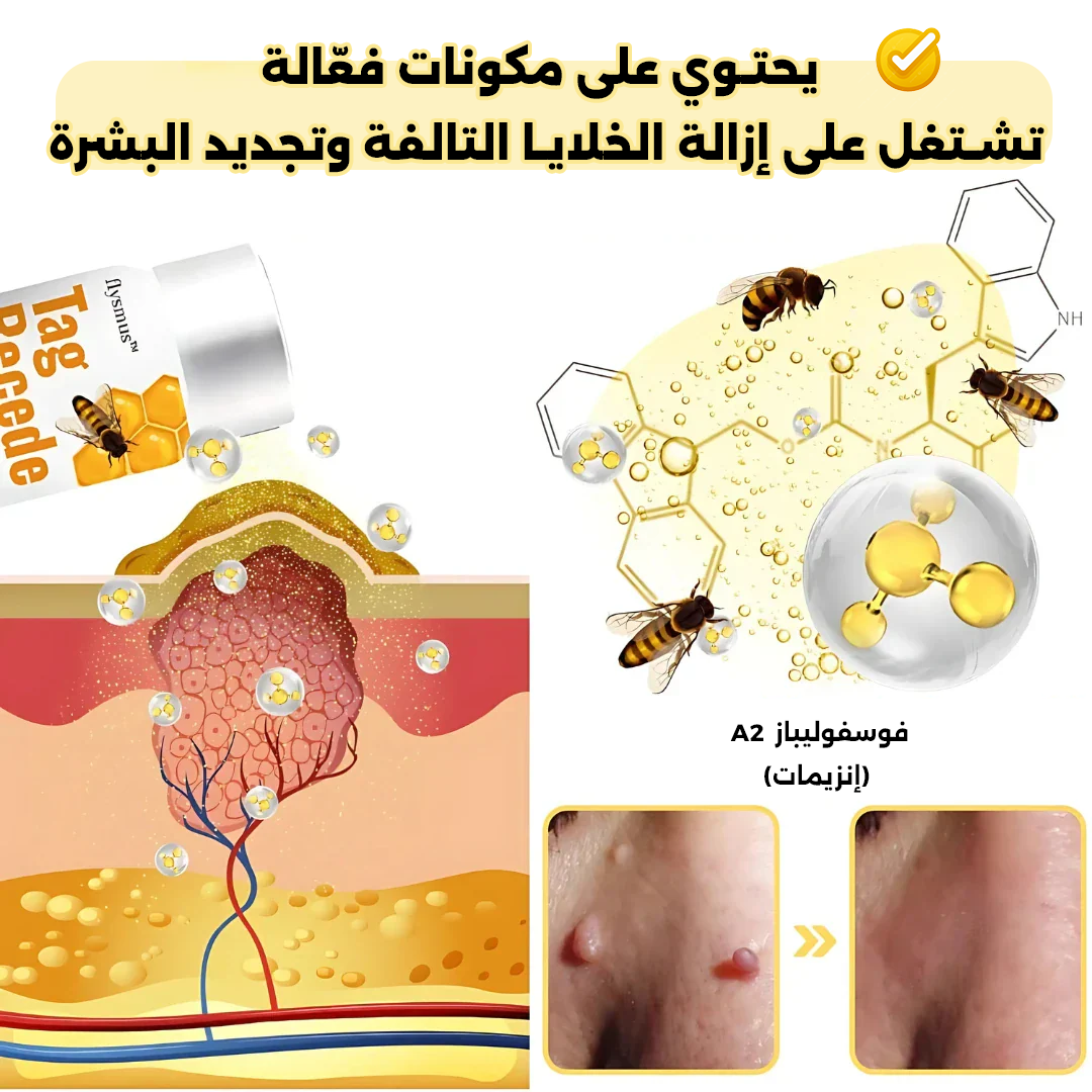 علاج الثآليل بسم النحل