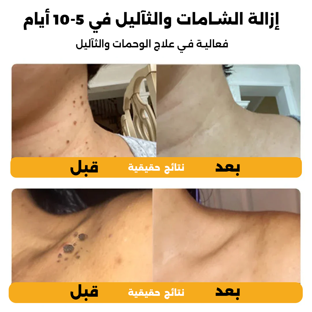 علاج الثآليل بسم النحل